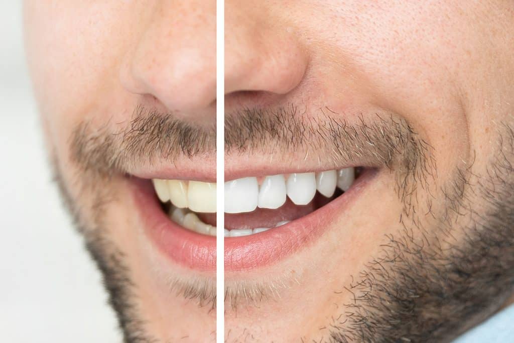 How Long Does Teeth Whitening Last?